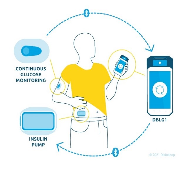 dexcom terumo